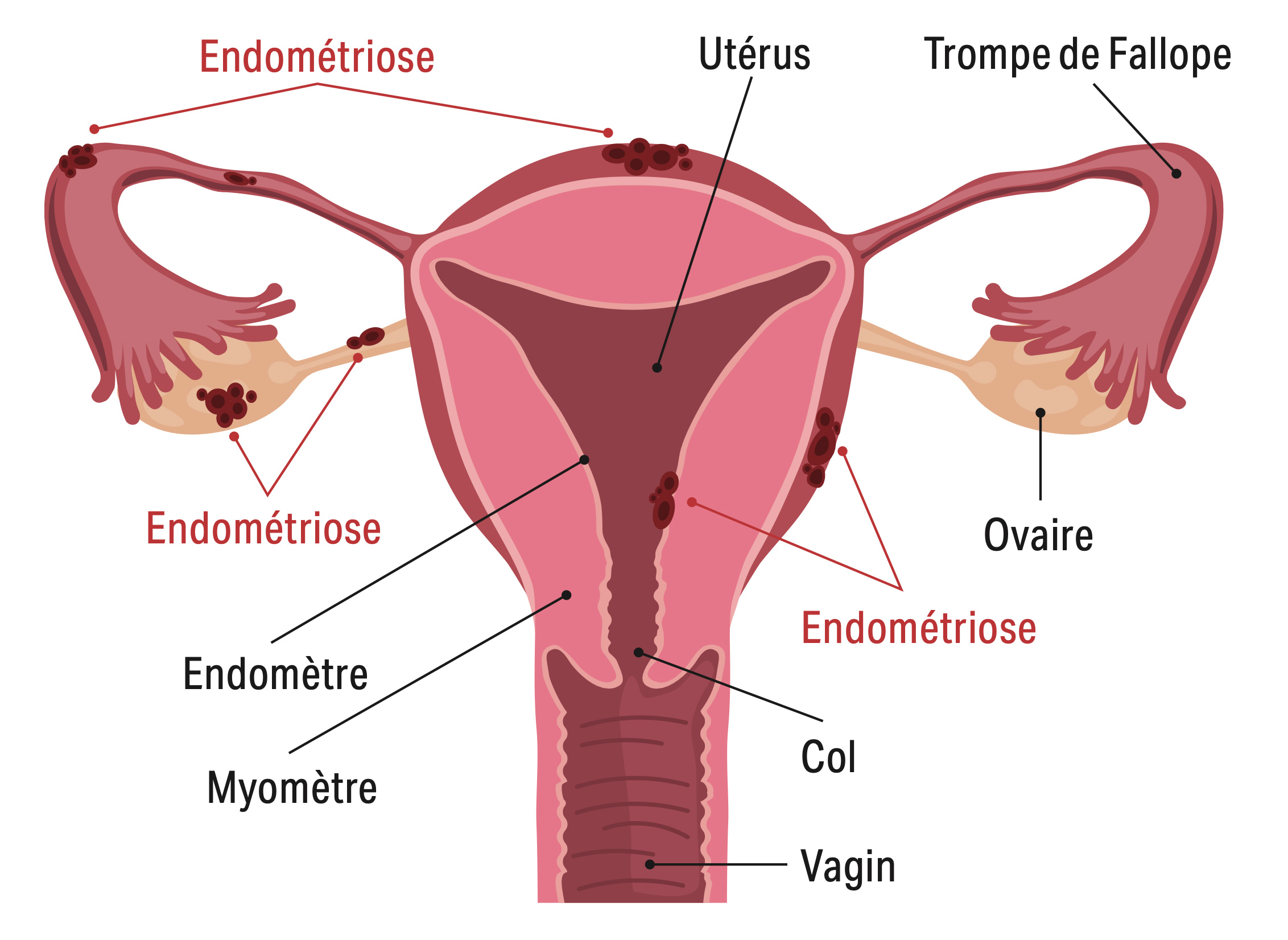 endometriose-graphique