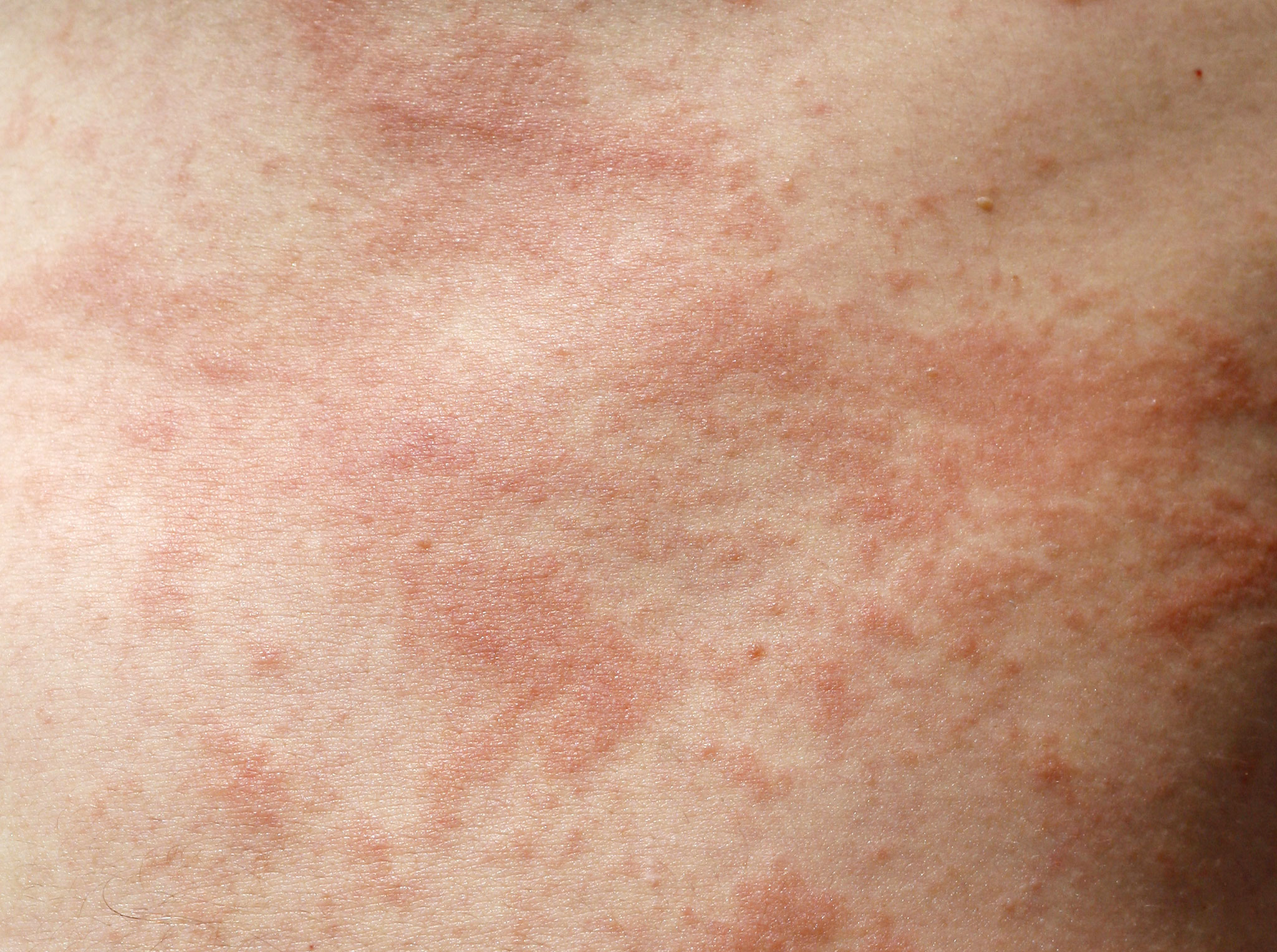 L’herbe à puce contient une sève vénéneuse qui provoque une inflammation de la peau.