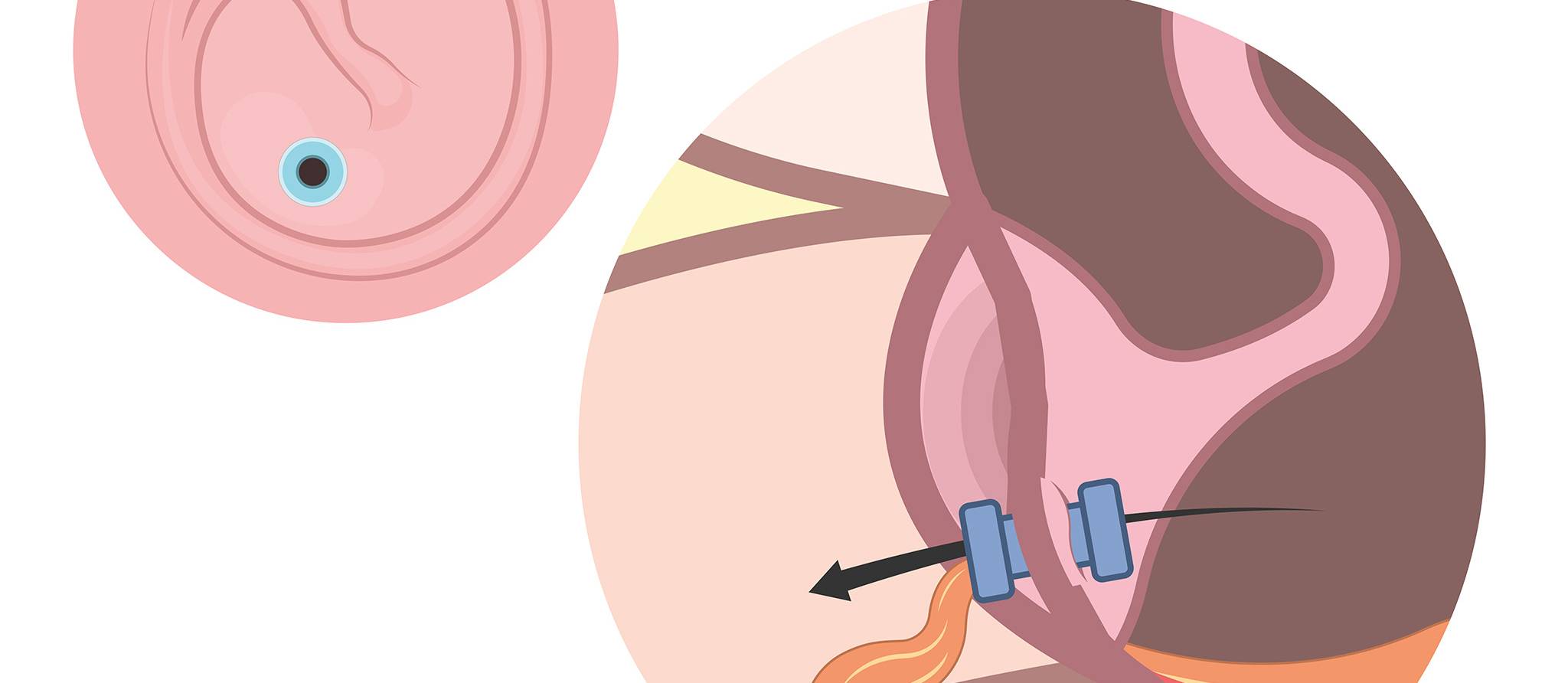 Les tubes dans les oreilles sont-ils la solution pour prévenir les otites?
