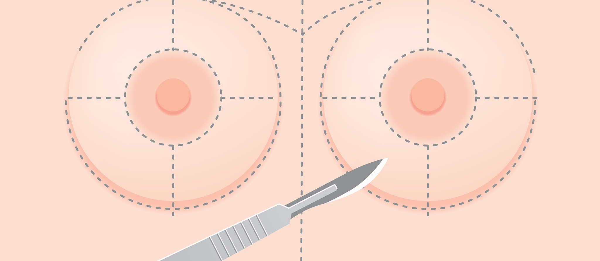 Faut-il craindre les implants mammaires?