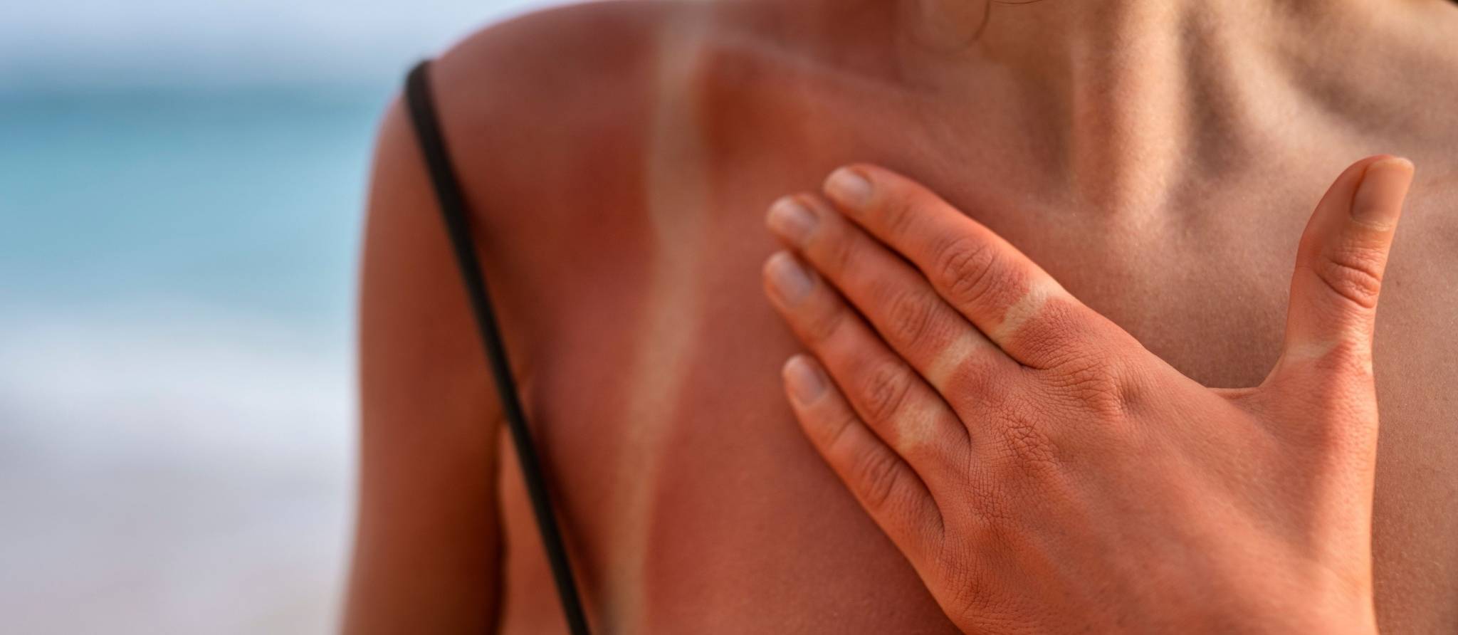 Coups de soleil: huit fausses idées sur le bronzage