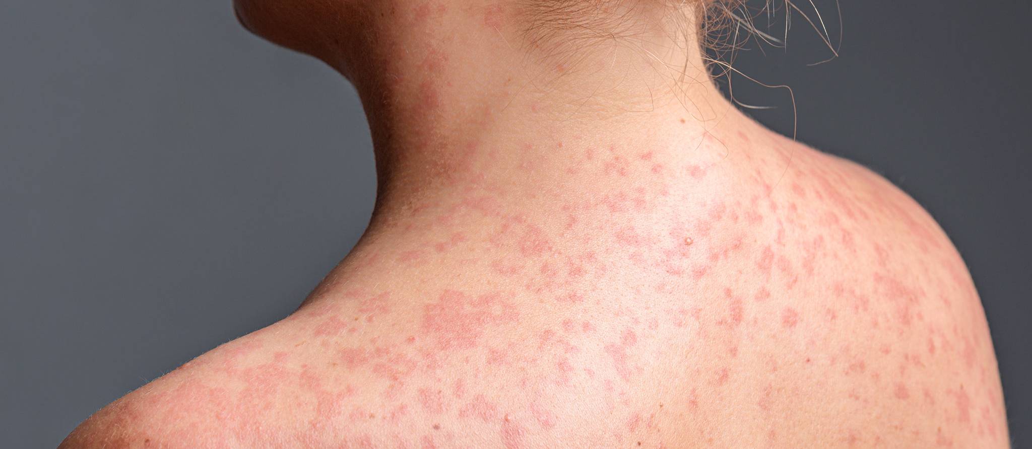 Une année marquée par la rougeole