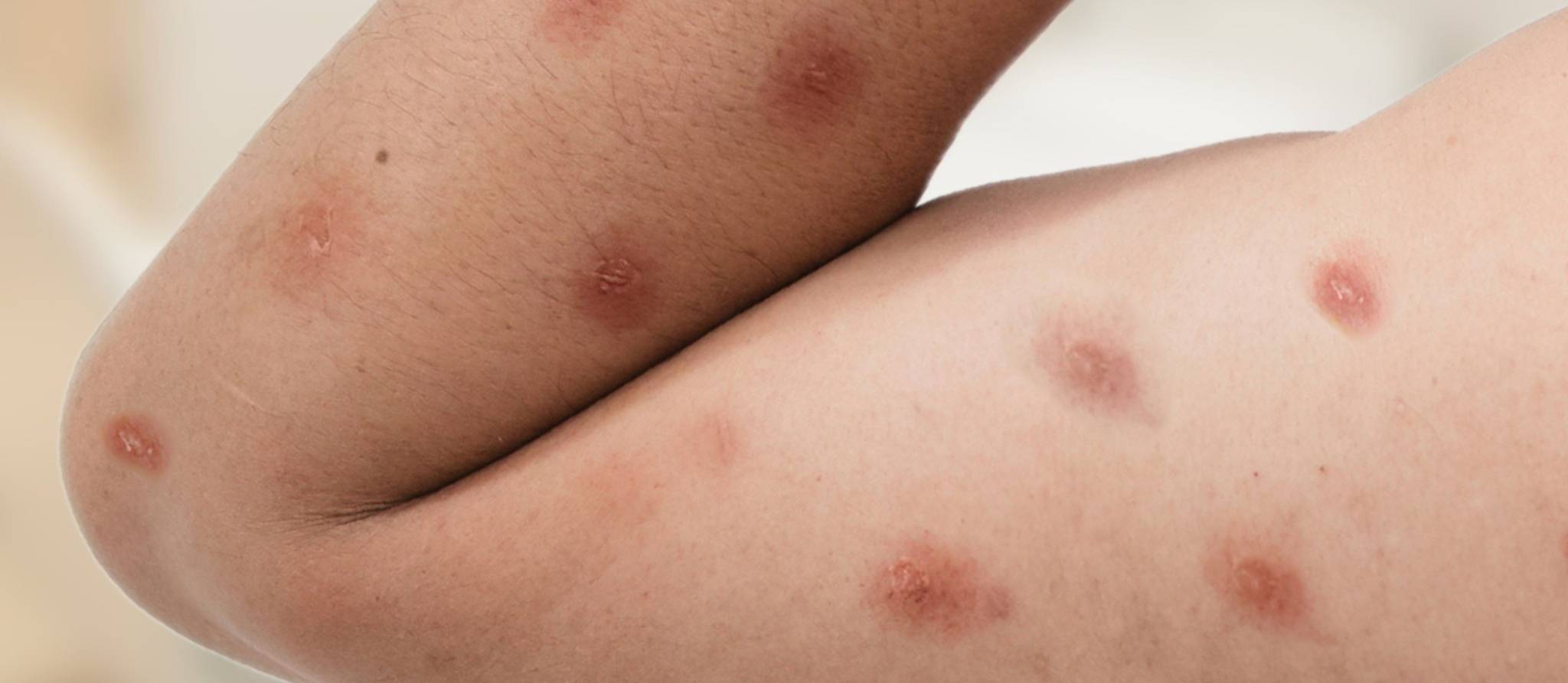 Recrudescence de mpox ou variole simienne