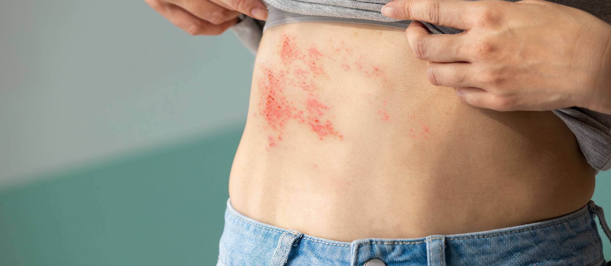 Vaccin contre le zona: pénurie de doses en pharmacie