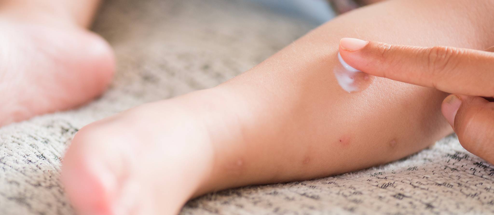Quelle crème pour soulager les piqures d’insectes et de moustiques?