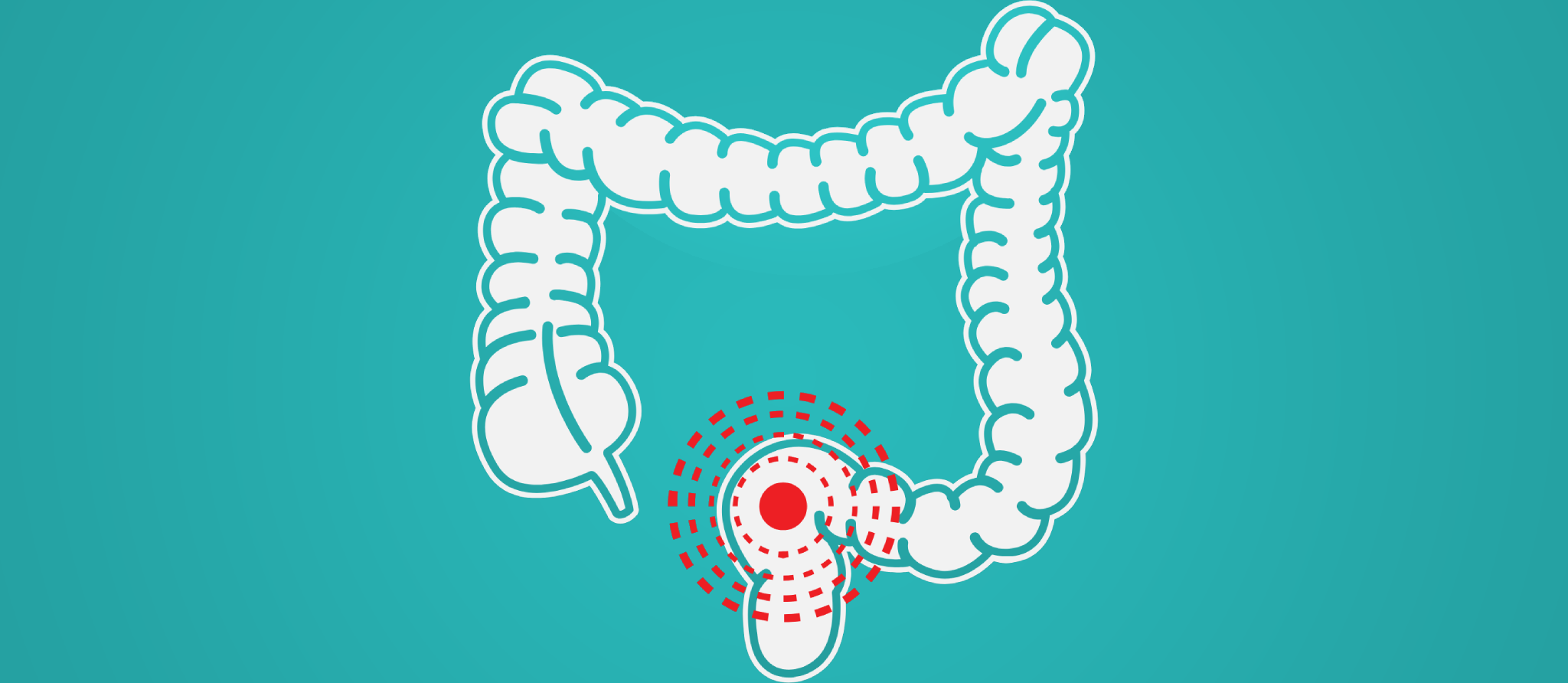 Cancer colorectal: le dépistage devient plus facile d’accès