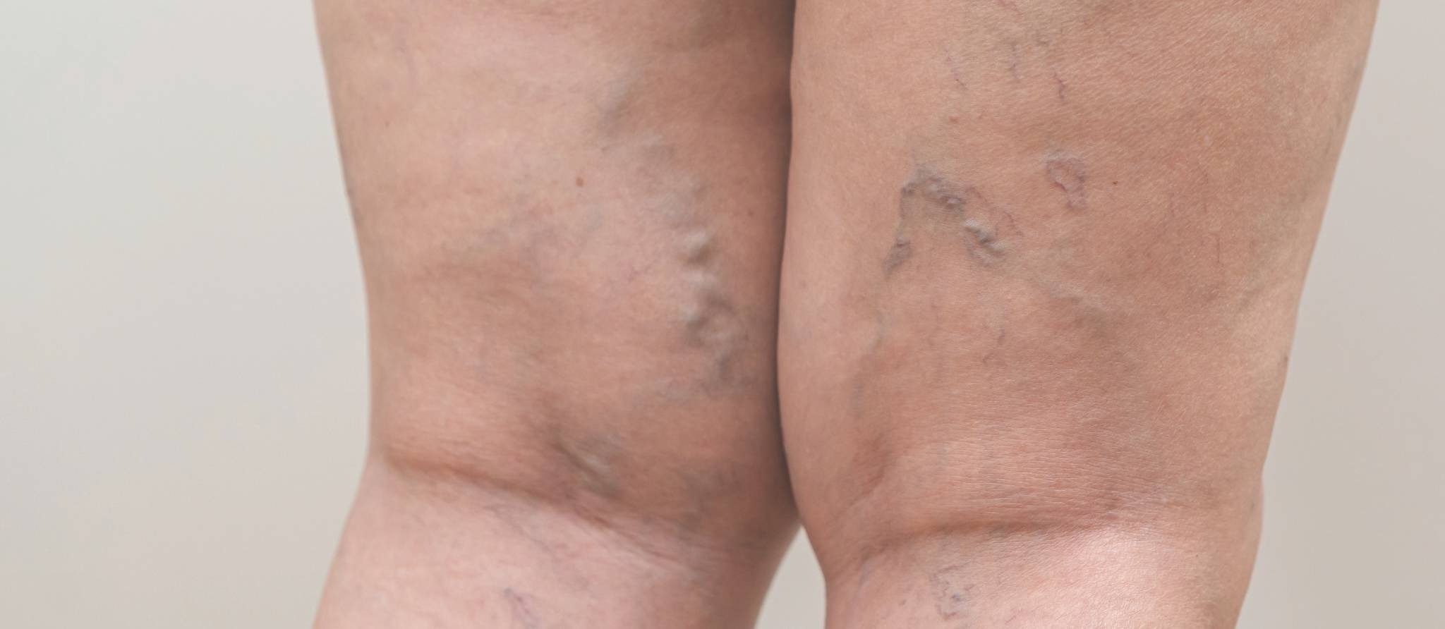 Comment prévenir et traiter les varices