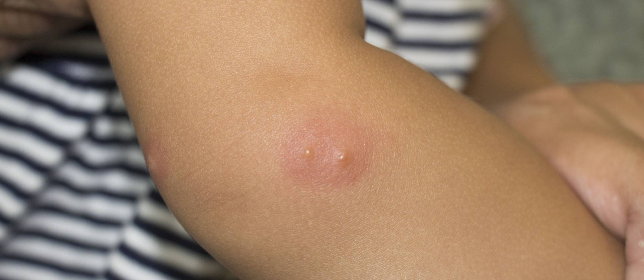 Enfant piqué par un insecte: quoi faire?