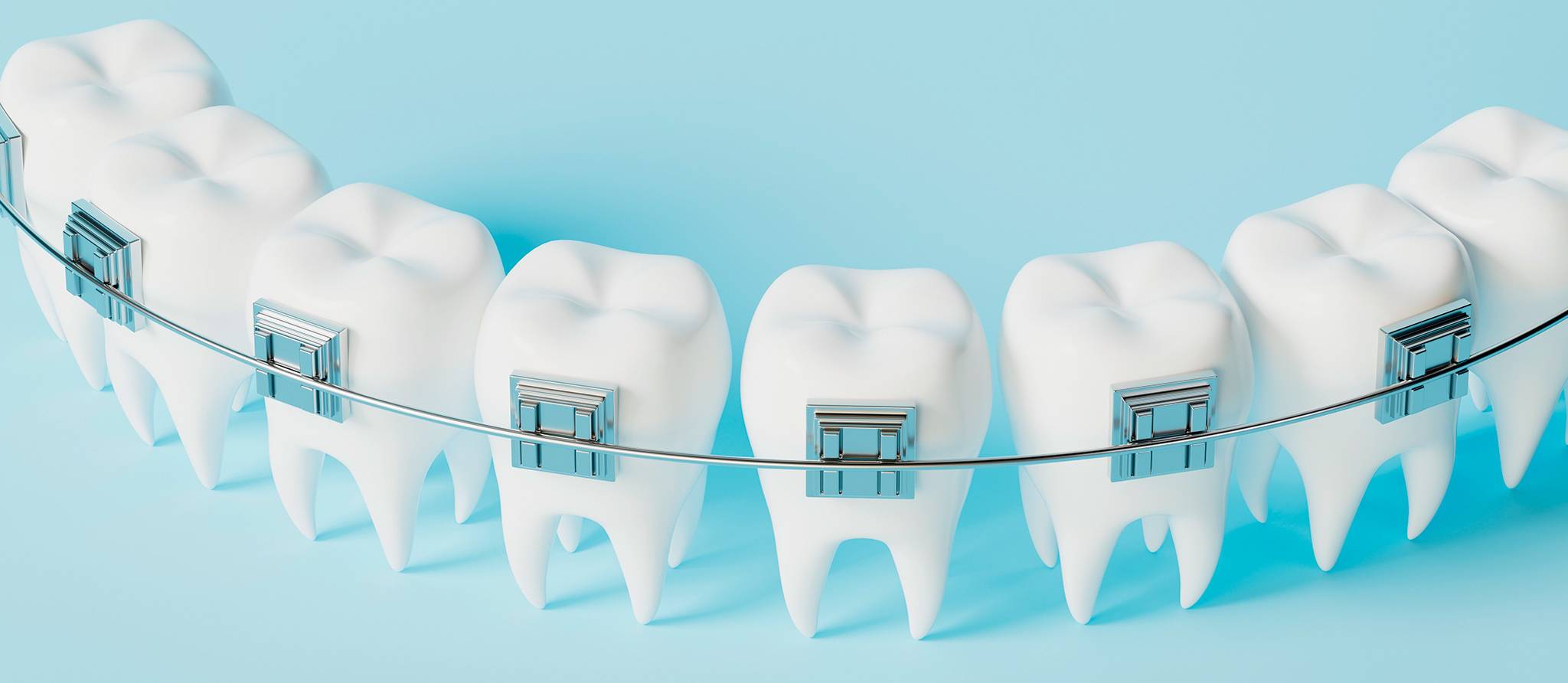 Les questions à vous poser avant d’entreprendre un traitement orthodontique