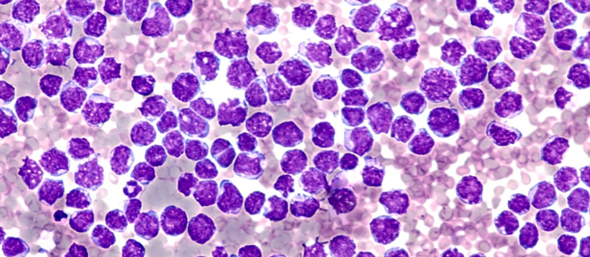 Alexandra Diaz : qu’est-ce que le lymphome du manteau ?