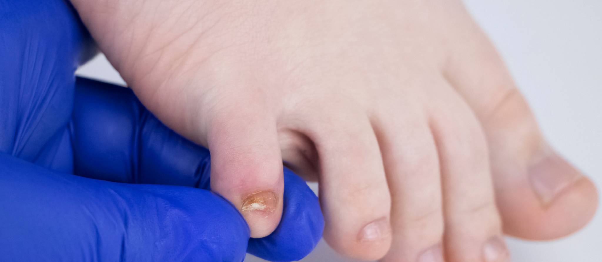 Mycose des ongles : quand faut-il traiter ?