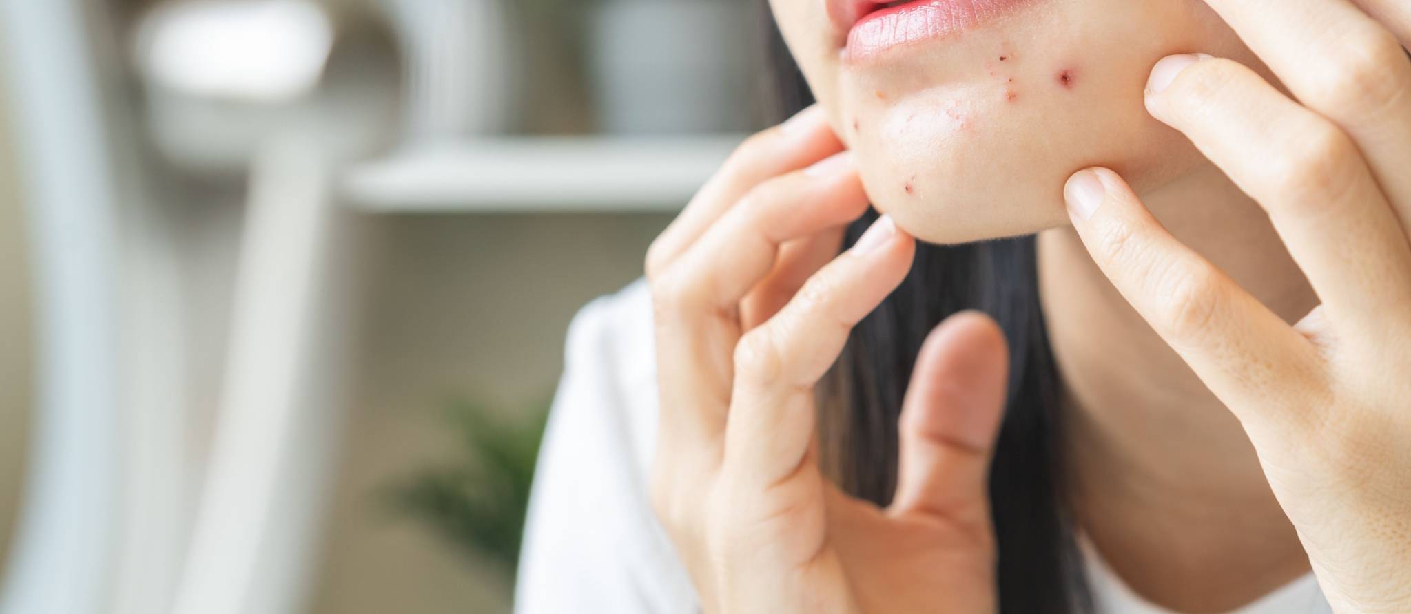 Boutons de stress : origines et traitements