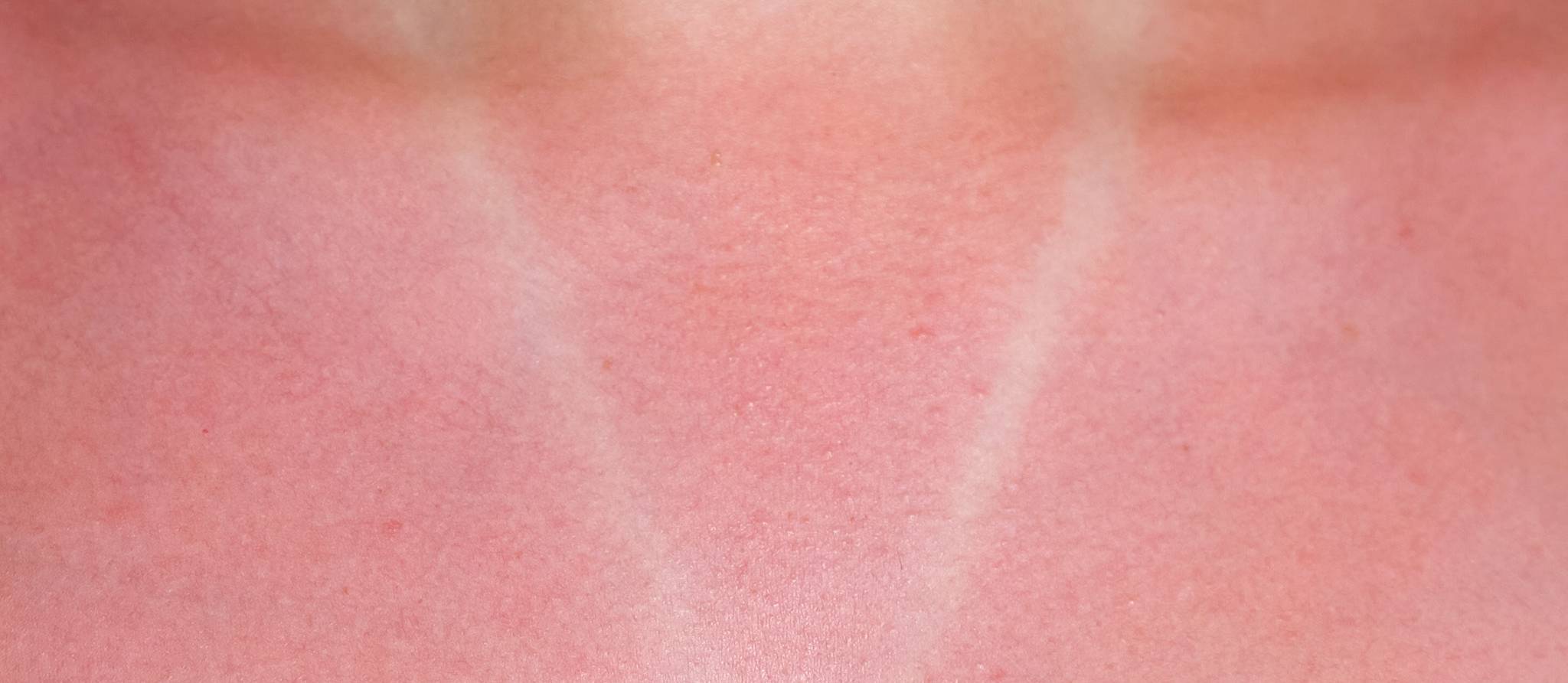 Un dangereux « Défi coup de soleil » sur TikTok