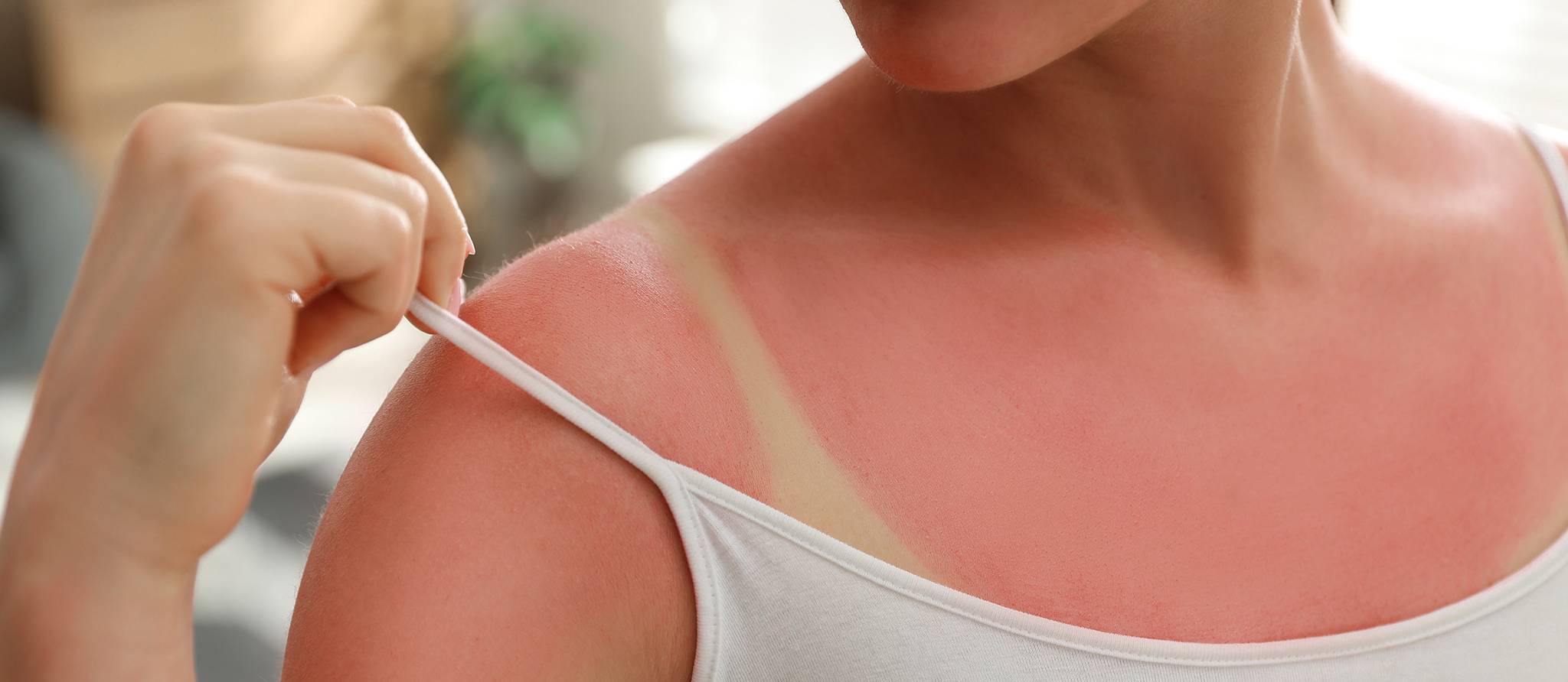5 conseils pour soigner un coup de soleil
