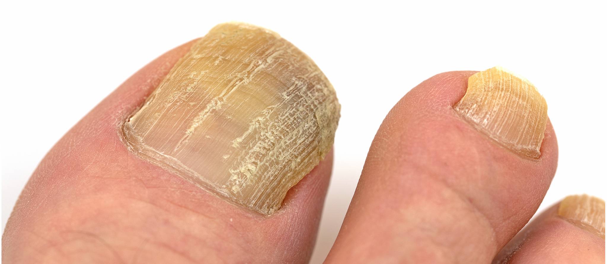Mycose des ongles: finis les traitements au laser