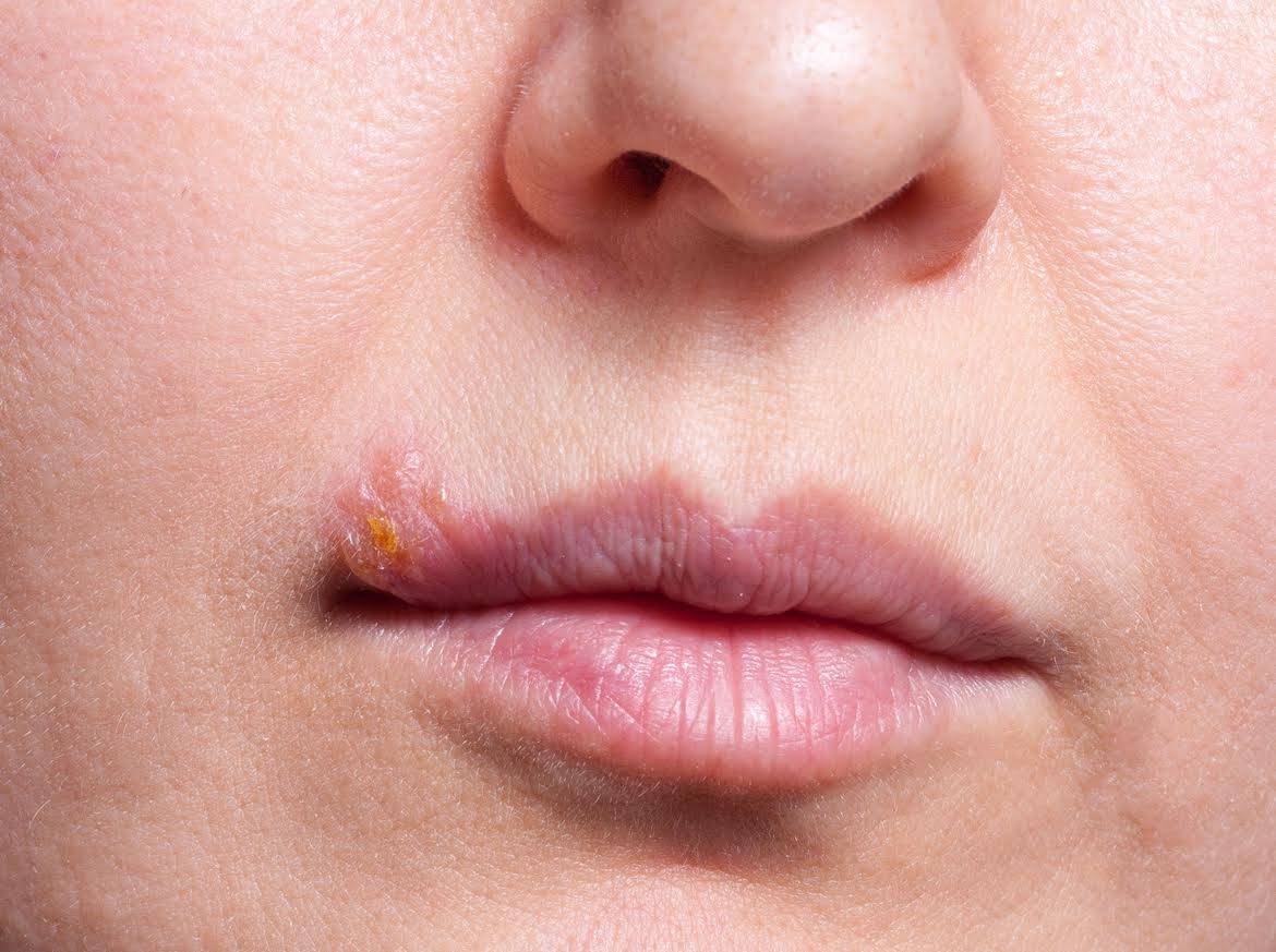 Comment prévenir et traiter les feux sauvages