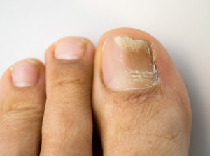 mycos-ongles-2