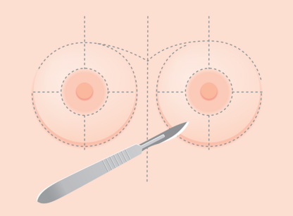 implants-mammaires