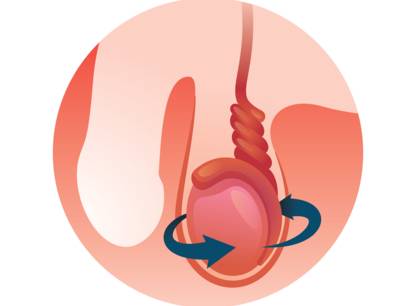 torsion-testiculaire