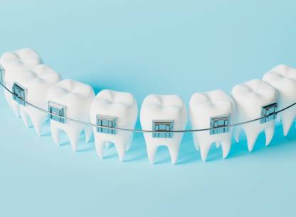 orthodontie-questions