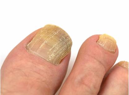 mycos-ongles
